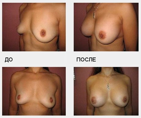 Фото До и После увеличения груди | Доктор Зыков